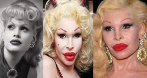Amanda Lepore Before and After Lip Injections