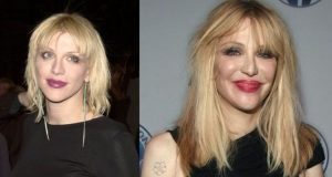 Courtney Love before and After Lip Injections