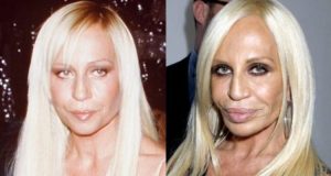 Donatella Versace Before And After Lip Injections