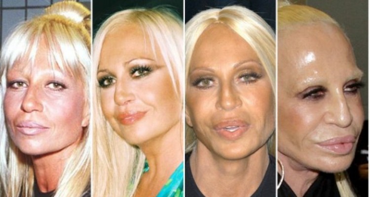 Donatella Versace Before And After Lip Injections