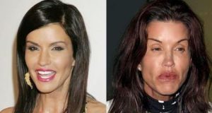 Ruined Janice Dickinson Before and After Lip Injections
