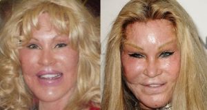 Jocelyn Wildenstein Before and After Lip Injections