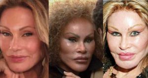 Jocelyn Wildenstein Before and After Lip Injections