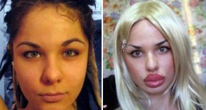 Kristina Rei Before and After Lip Injections