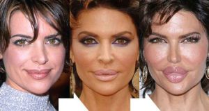 Lisa Rinna Before and After Lip Injections Gone Bad