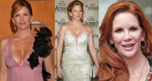 Accusations of Melissa Gilbert Plastic Surgery