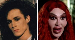 Pete Burns Before and After Lip Injections