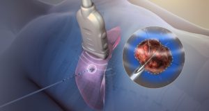What is Arthroscopic Laser Facet Ablation?