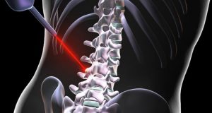 Laser Spine Surgery Procedure, Cost and Risks