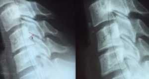 The Result of Surgical Removal of Bone Spurs In Neck