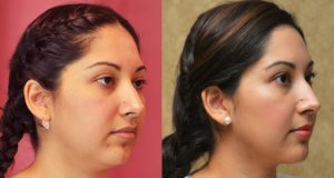 Face Liposuction Risk