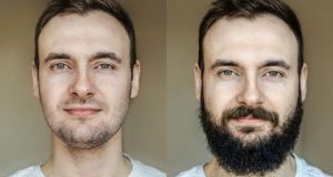 Facial Hair Transplant Side Effects