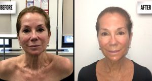 How Ultherapy Facelift without Surgery