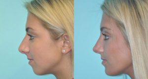 Information About Chin Implants Before and After