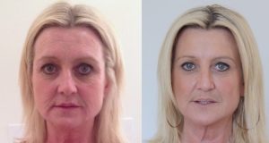 New Facelift Procedure Without Surgery