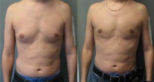 Reduce Male Breast Size Naturally